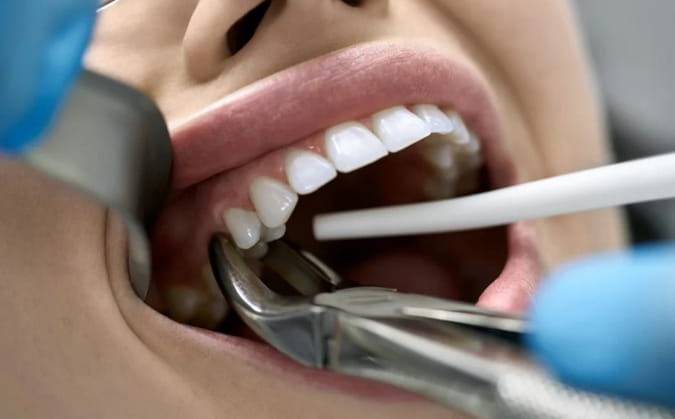 Видалення зуба